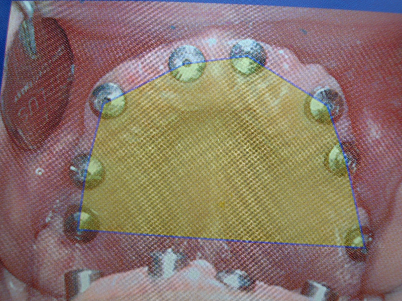 curso-implantes-0051