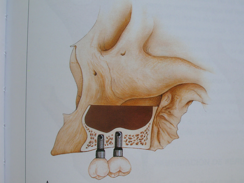 curso-implantes-048
