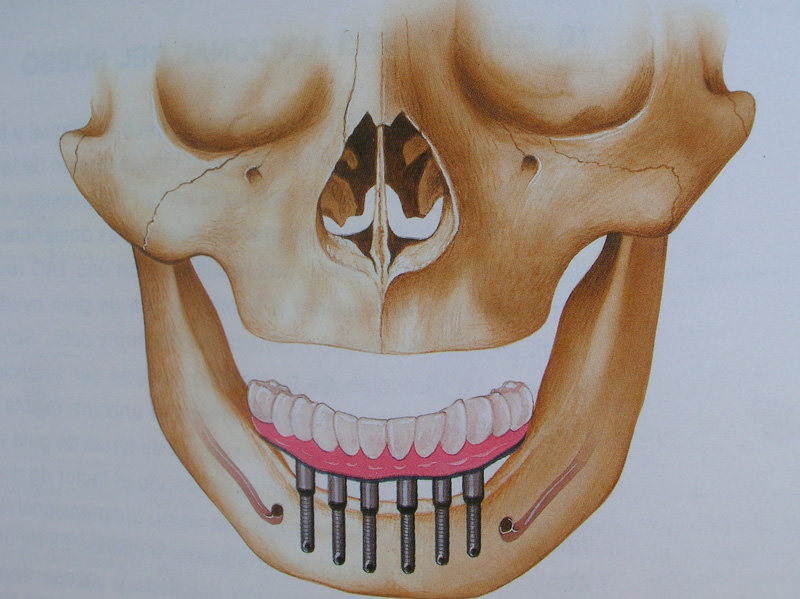 curso-implantes-049