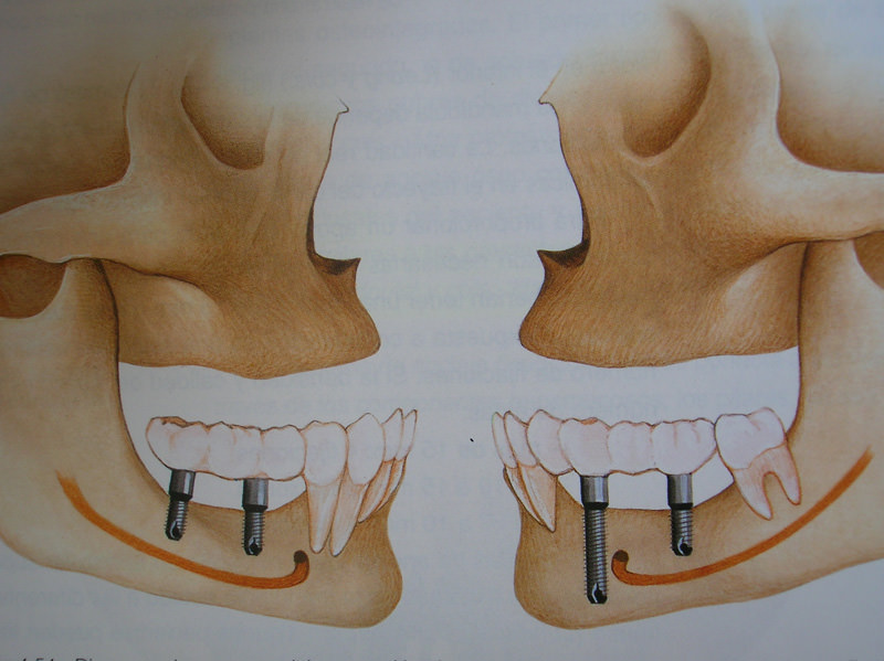 curso-implantes-060