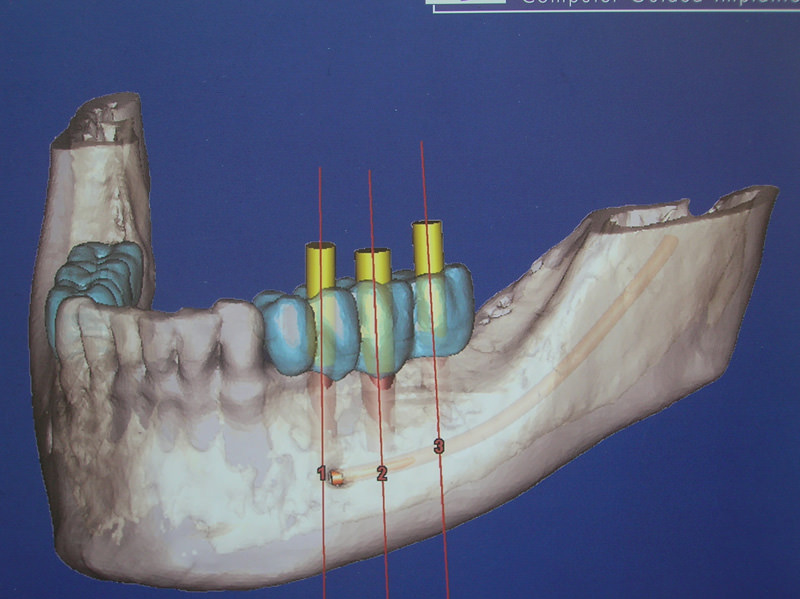 curso-implantes-061