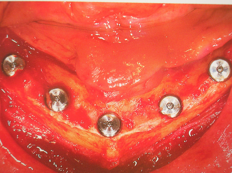 curso implantes 062