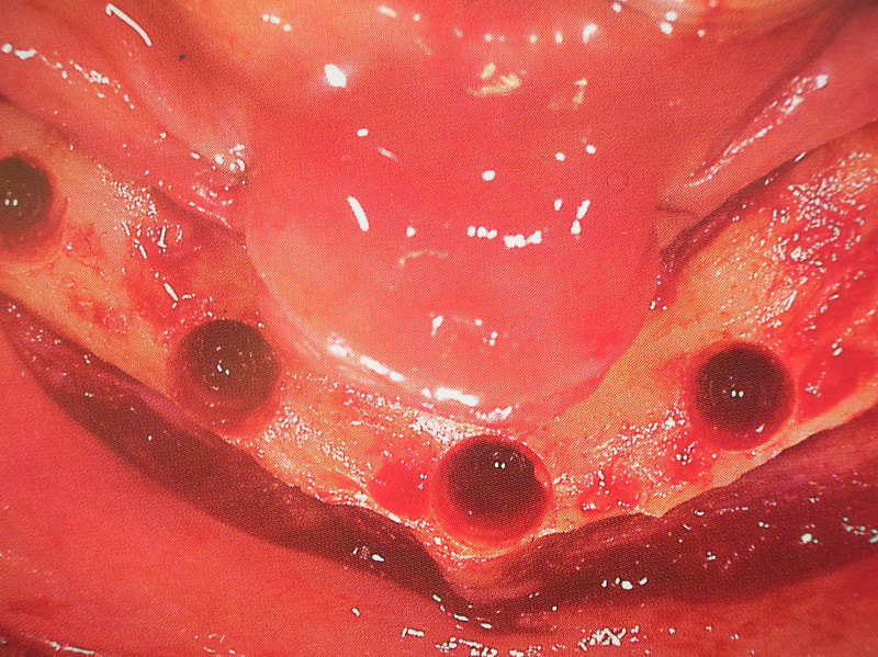 curso-implantes-063