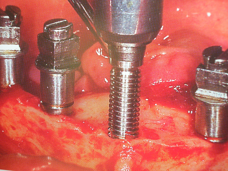 curso-implantes-0650