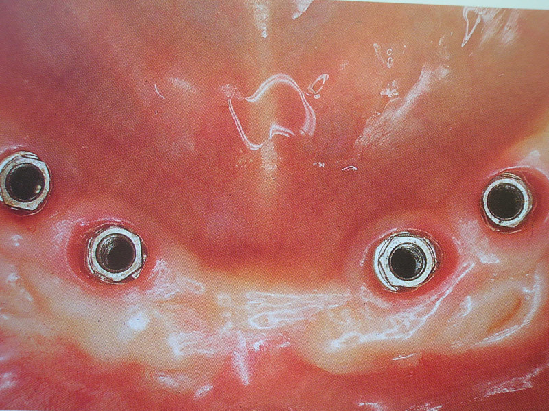 curso implantes 067