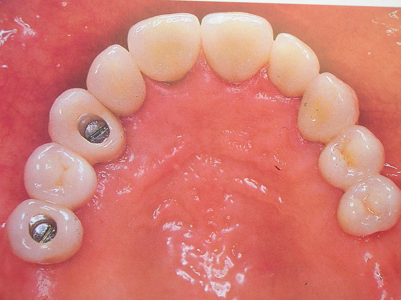curso-implantes-071
