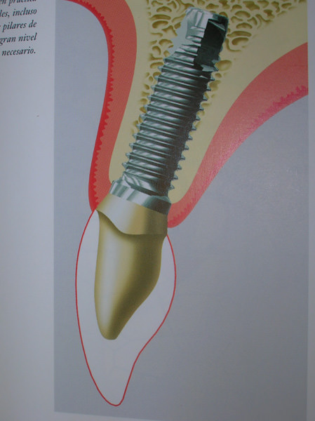 endodoncia