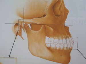1+1 Férula Dental Placa de Descarga Nocturna - Protector Bucal para dormir  anti Bruxismo Rechinar los dientes y los Trastornos del ATM - Con