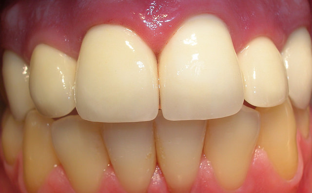 cambio corona metal-ceramica por zirconio - Natural Smile