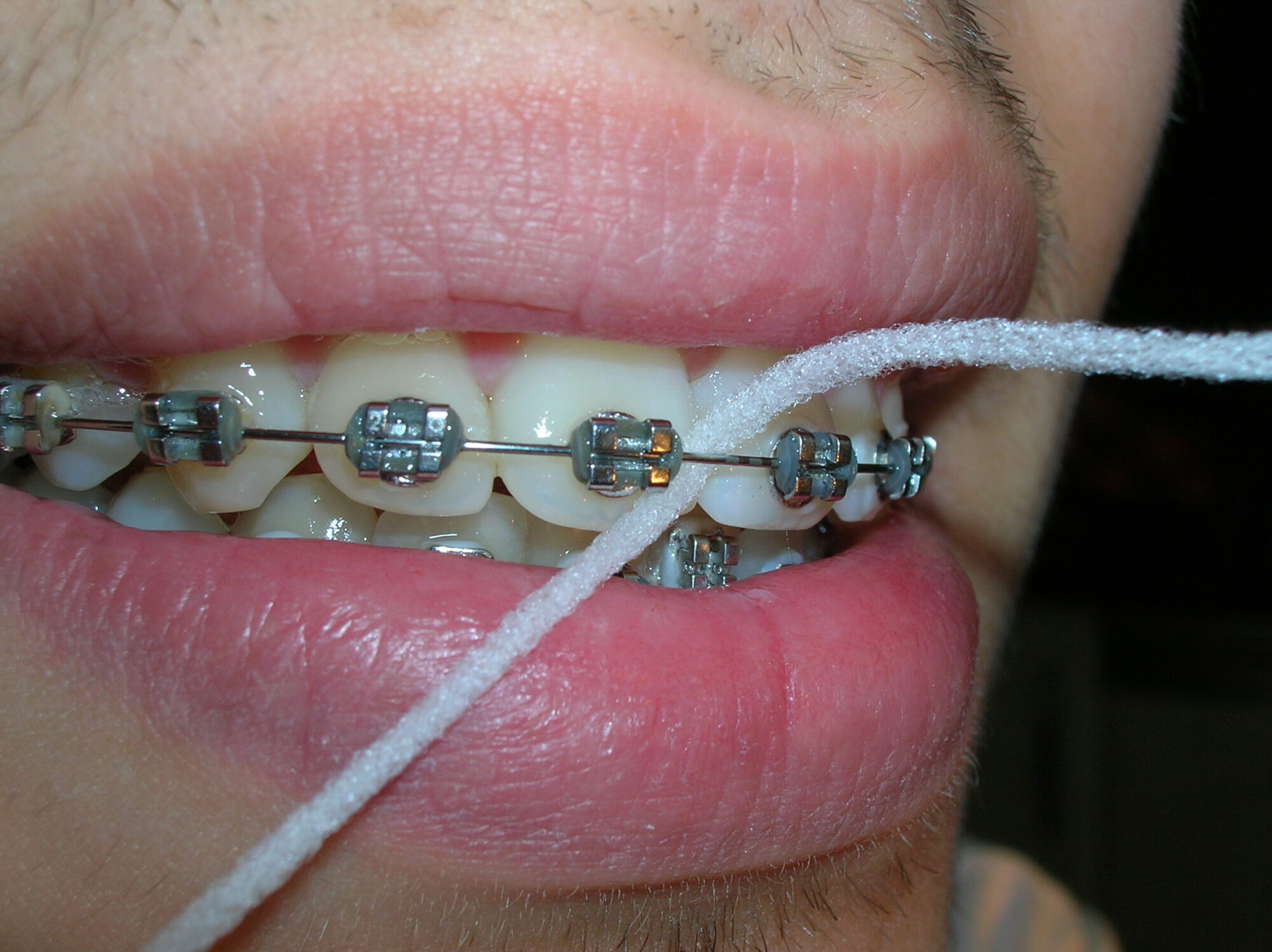 Cinta y braquets de ortodoncia