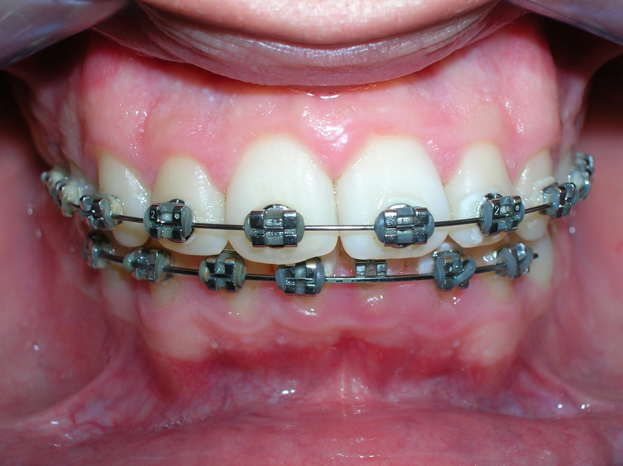 Cinta dental brackets
