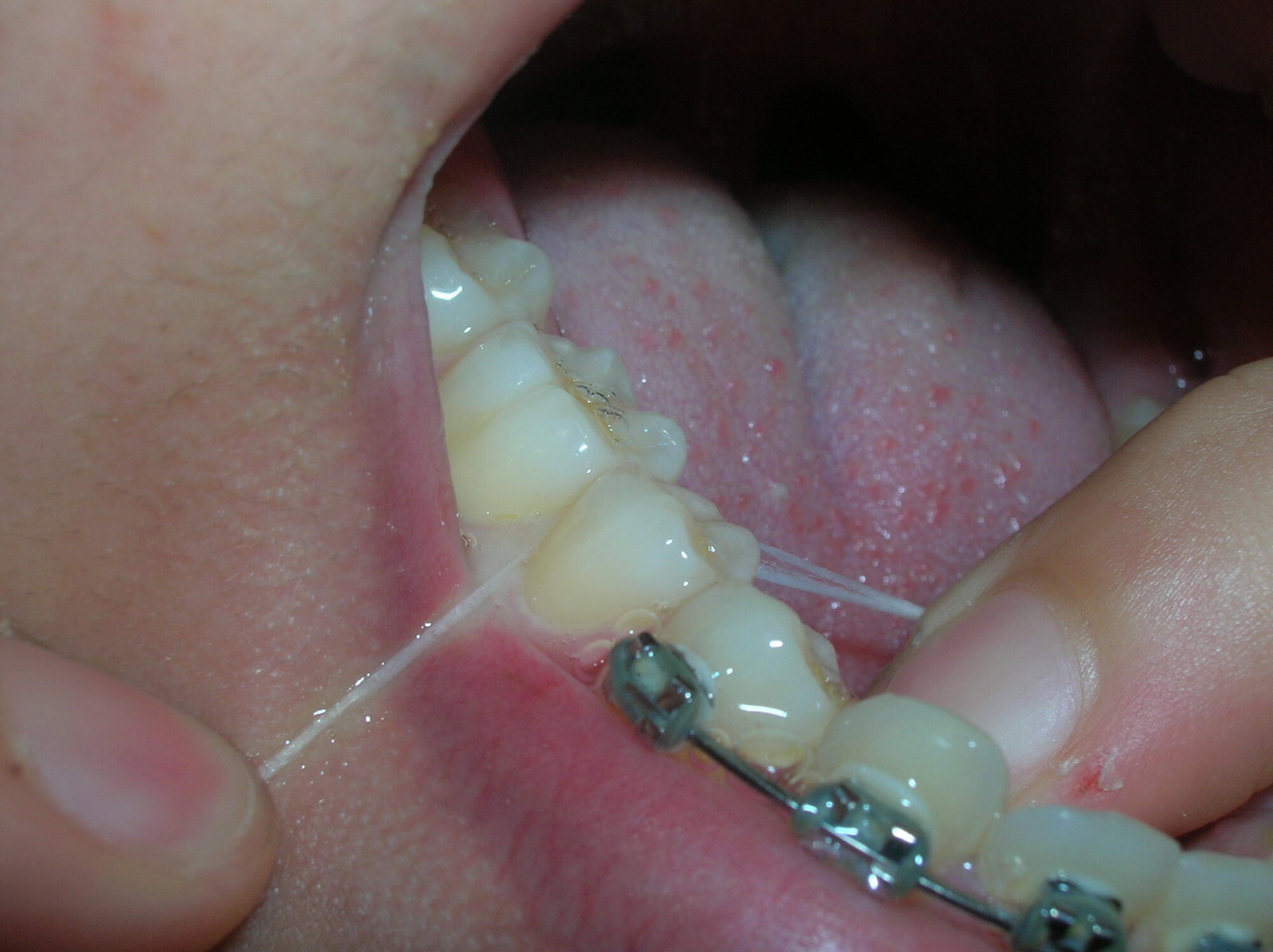 Cinta dental molares inferiores