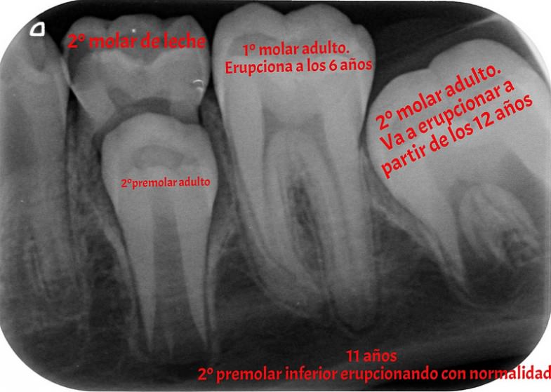 Dientes de leche lo que necesitas