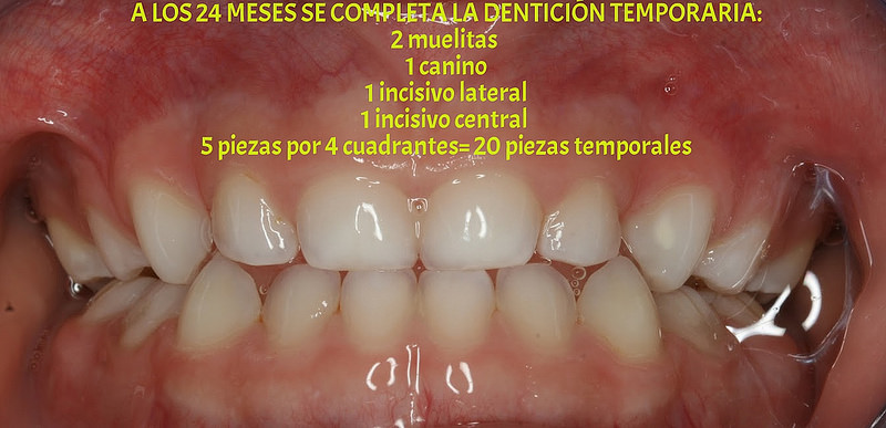 Fórmula dentaria caduca 2muelas+1canino+1incisivo lateral+1incisivo central = 5 piezas por cuadrante x 4 cuadrantes = 20 piezas temporarias