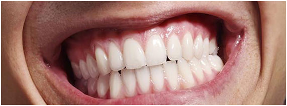 oclusion-dental