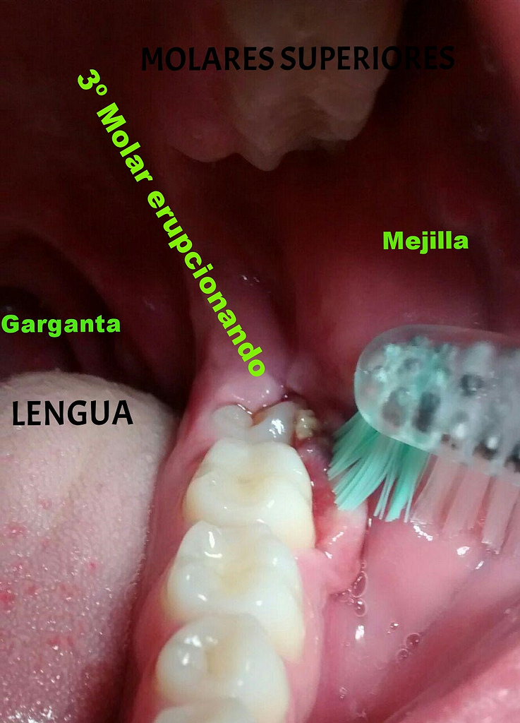 Pericoronitis