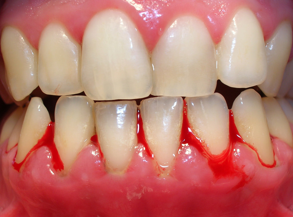 Gingivitis 2