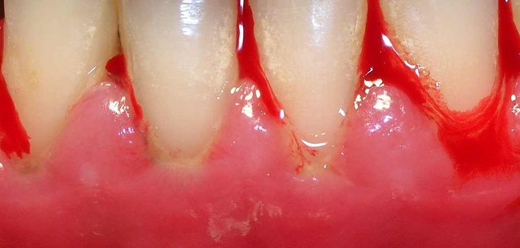 Gingivitis 3