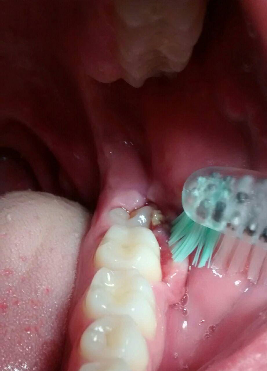 Pericoronitis