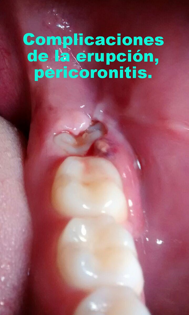 Pericoronitis Pus