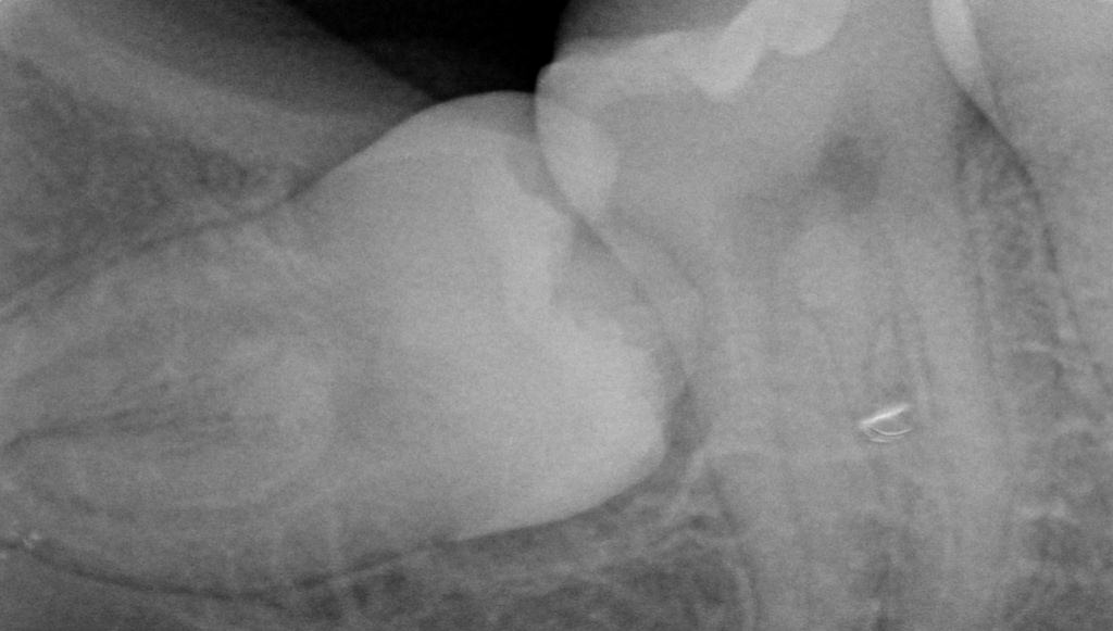 Tercer molar inferior