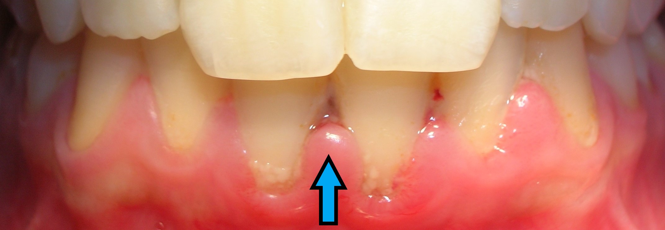 Antes sarro manchas y gingivitis