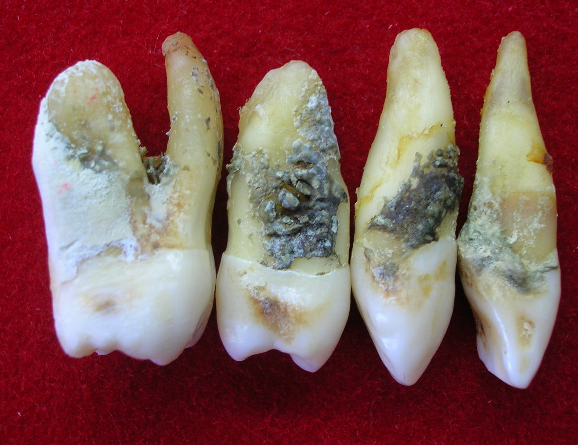 Sarro o cálculo dental