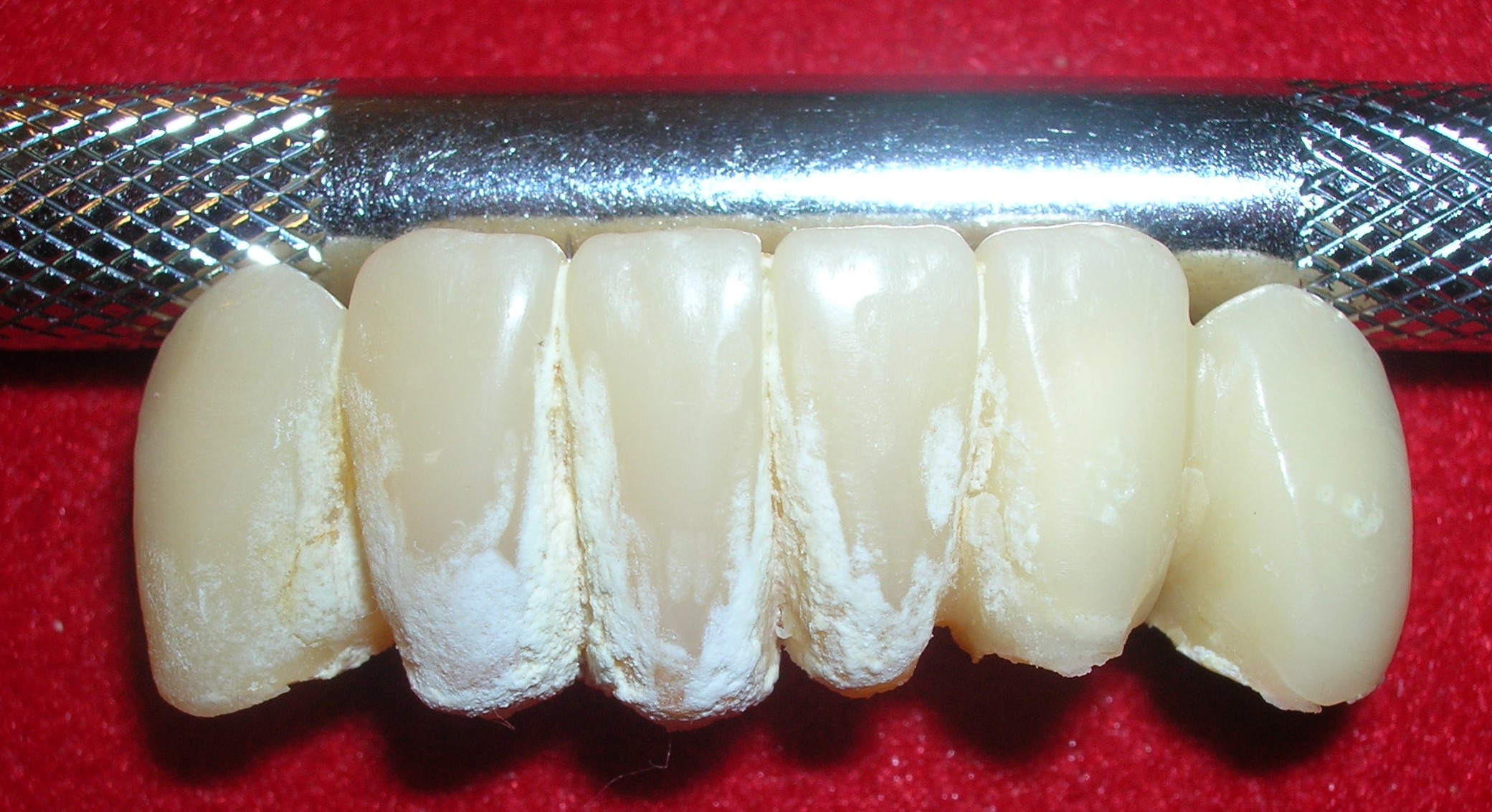 Cálculo dental sobre dientes provisionales