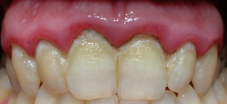 Cuanto Tarda En Despertar La Anestesia Del Dentista
