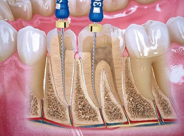 Pórtico ~ lado tarjeta Qué es una Endodoncia? - juanbalboa.com