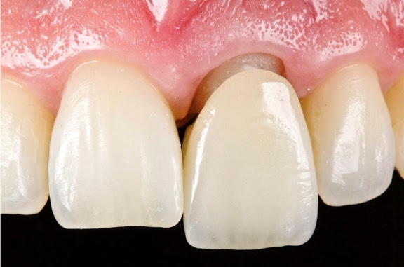 Dento Clínic Parral - ✓Cementación de Corona Metal Porcelana Molar  Inferior. Gracias a su resistencia y al precio más asequible en comparación  con otros tipos de coronas, la corona de metal-cerámica es