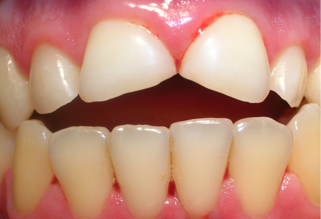Dientes fracturados